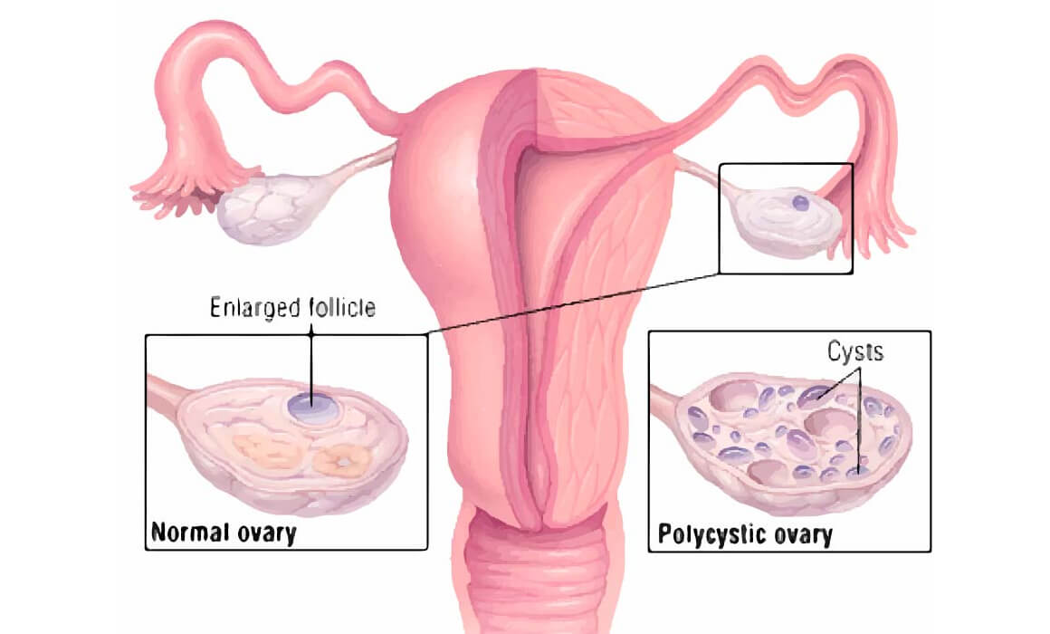 sindrome ovaris poliquistics sop