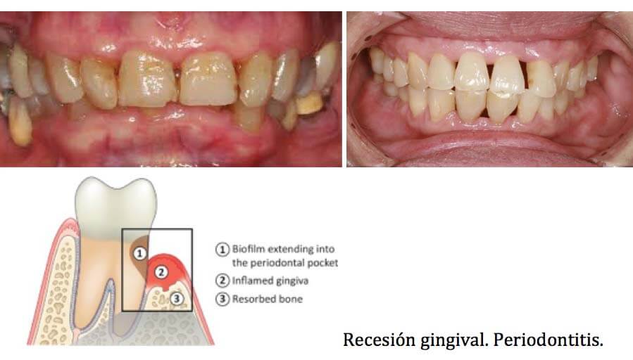 solución periodontitis gingivitis